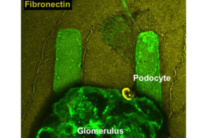 Pathways To Finding Treatments For Kidney Disease