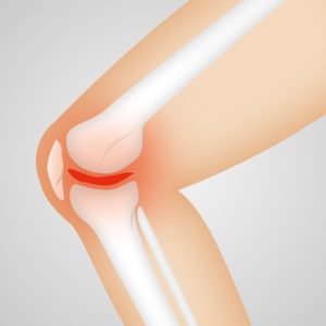 Treating And Preventing Osteoarthritis