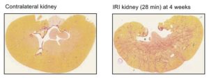 Potential Treatment For CKD