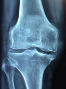 AI Detects Early Osteoarthritis From X-Ray Images – MEDICAL & HEALTH – AI