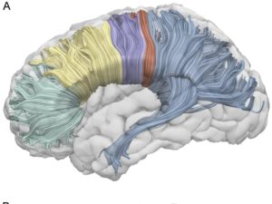 Corpus Callosum Switches Off Right Hemisphere During Speech