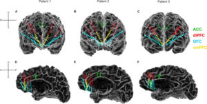 Progress In Unlocking The Brain’s Code For Depression^