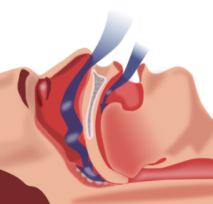 Obstructive Sleep Apnea May Directly Cause Early Cognitive Decline