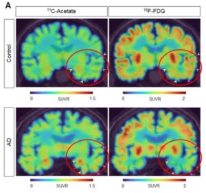 Major Alzheimer’s Research Breakthrough