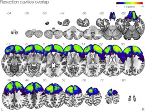 Brain Connections & Epileptic Seizures