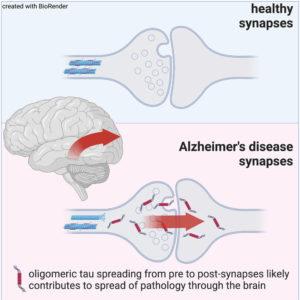 Dementia Study Reveals How Toxic Proteins Spread Through Brain – 3P™