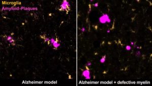 Poorly Insulated Nerve Cells Shown To Promote Alzheimer’s Disease – Demylanization & MS – 3P™