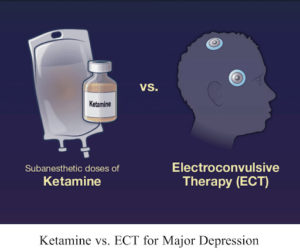 Ketamine vs. Electroconvulsive Therapy For Major Depression – 3P™