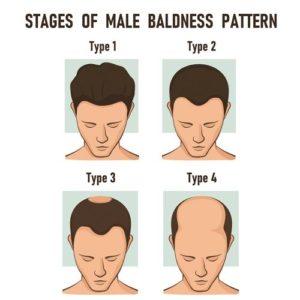 Rare Gene Variants That Play A Role In Hereditary Male Hair Loss