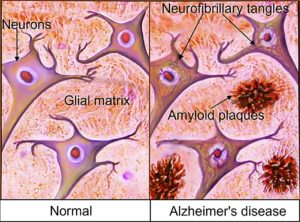 Radiologists Must Monitor Novel Alzheimer’s Treatment Side Effects – 3P™