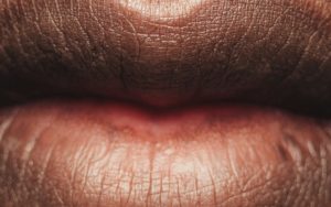 Risk of dementia after mouth herpes simplex virus  – A4DP™