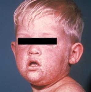 MEASLES ERUPTS IN FLORIDA’S UNVACCINATED