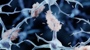 Stress and alcohol accelerate Alzheimer’s – A4DP™