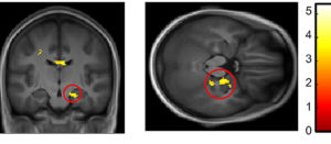 Investigating hyperactivation of memory circuits and Alzheimer’s disease – A4DP™