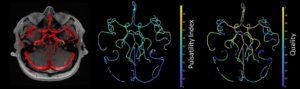 New metric for blood circulation in brain to better understand dementia^ – A4DP™