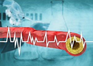 Scoring system can avoid unnecessary surgery for clogged arteries