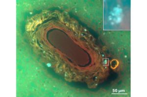 Link between vascular disease and dementia risk-  A4D™