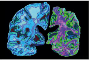 Newly discovered Alzheimer’s mechanism is linked to brain inflammation- A4D™