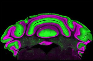 Assumption about brain activity in tremors—A4D™